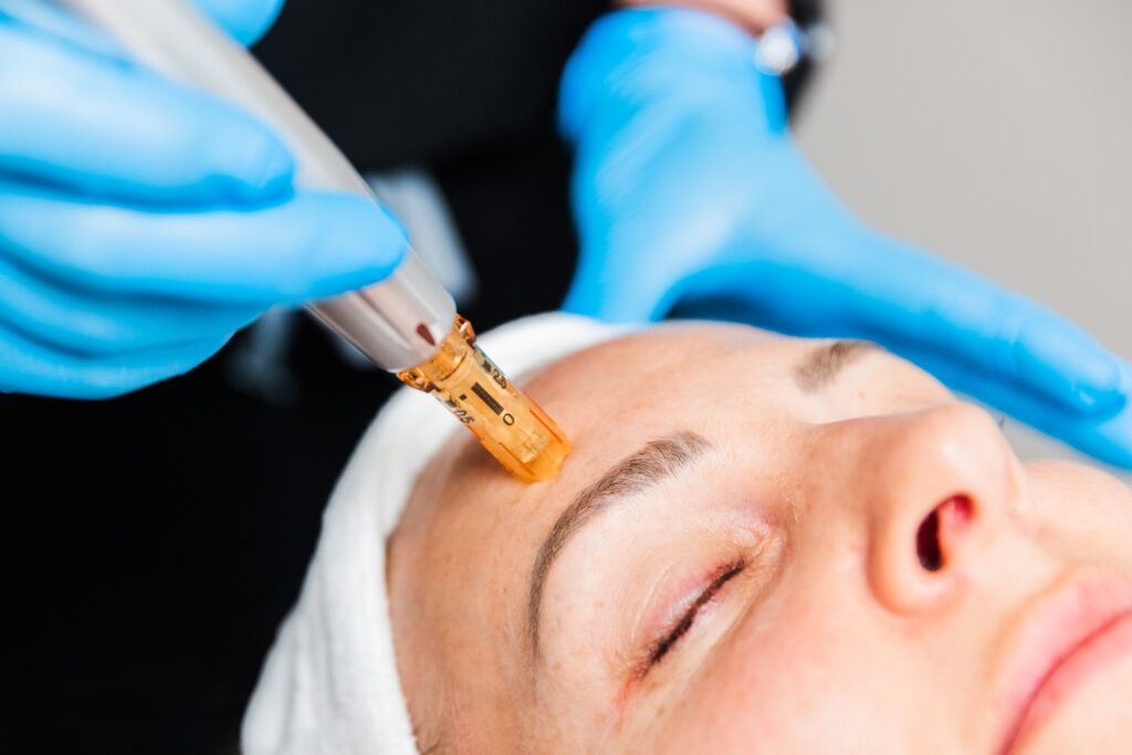 close-up of a professional with blue gloves performing microneedling in Franklin, TN, on a female patient's face